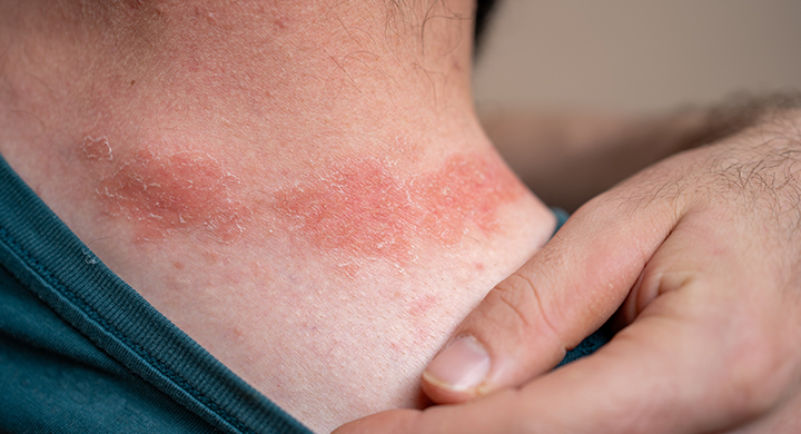 Overview: Cold Weather as a Factor in Skin Allergies